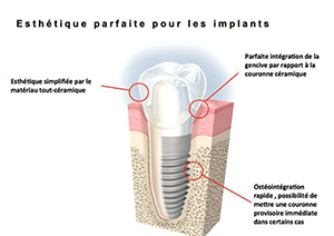 Chirurgie pré-implantaire à Neuilly sur Seine