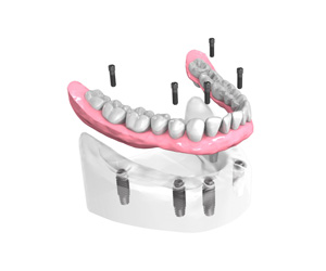 Remplacer toutes les dents absentes ou abîmées - Dentiste Neuilly sur Seine