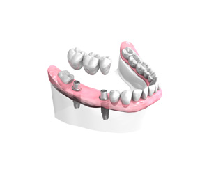 Remplacer plusieurs dents absentes ou abîmées - Dentiste Neuilly sur Seine