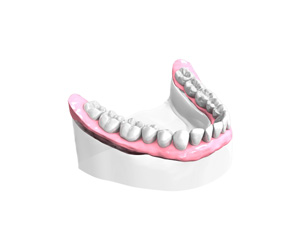 Remplacer plusieurs dents absentes ou abîmées - Dentiste Neuilly sur Seine